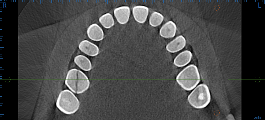 歯の寿命は何年？虫歯がなくても歯が割れる理由を咬み合わせ専門医が解説｜吉本歯科医院（香川県高松市）