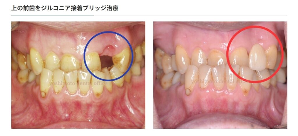 インプラントより接着ブリッジが適している人とは？｜咬み合わせ専門 吉本歯科医院（香川県高松市）