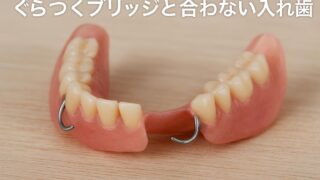 もう入れ歯は嫌だ！ぐらつくブリッジと合わない入れ歯でご相談