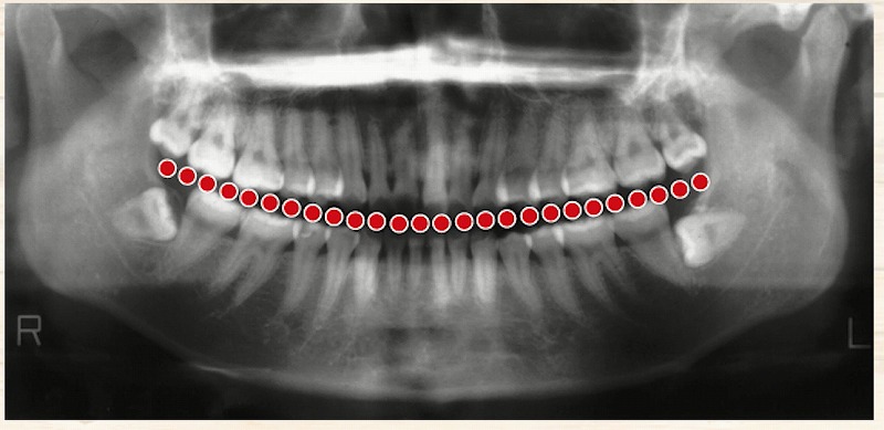 顎が痛い原因は噛み合わせのズレ？ 香川県高松市で顎関節症に悩む方へ｜咬み合わせ専門の吉本歯科医院