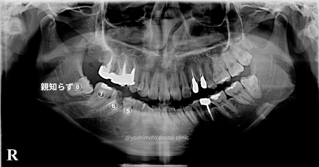 何度も同じところが虫歯になる原因｜香川県高松市のかみあわせ専門　吉本歯科医院