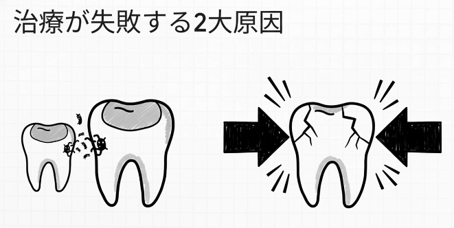 繰り返す虫歯｜虫歯菌ではなく咬み合わせが原因かもしれません｜咬み合わせ専門歯科　香川県高松市の吉本歯科医院