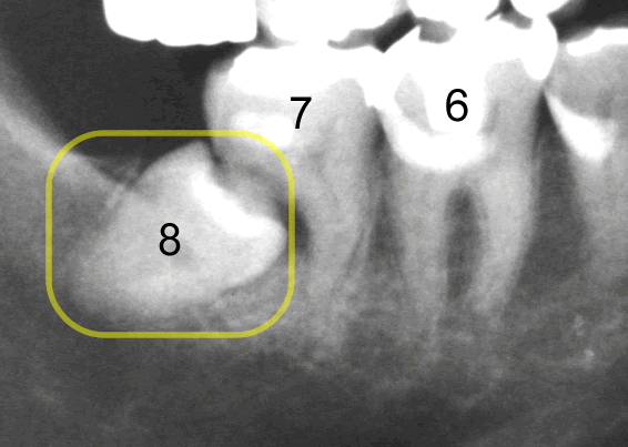 繰り返す虫歯｜虫歯菌ではなく咬み合わせが原因かもしれません｜咬み合わせ専門歯科　香川県高松市の吉本歯科医院