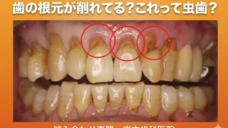 歯の根元が削れてる！？その正体は「くさび状欠損」かもしれません