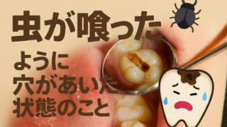 【衝撃の事実】「虫歯」＝ばい菌だと思っていませんか？