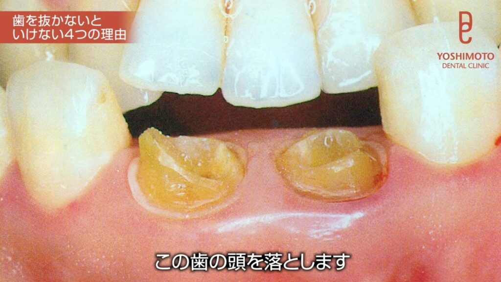 歯を抜きたくない|抜歯と言われた方へ|吉本歯科医院が考える抜歯の基準【香川県高松市】