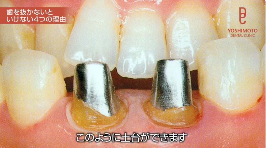 歯を抜きたくない|抜歯と言われた方へ|吉本歯科医院が考える抜歯の基準【香川県高松市】