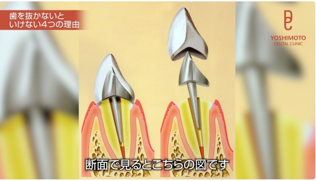 歯を抜きたくない|抜歯と言われた方へ|吉本歯科医院が考える抜歯の基準【香川県高松市】