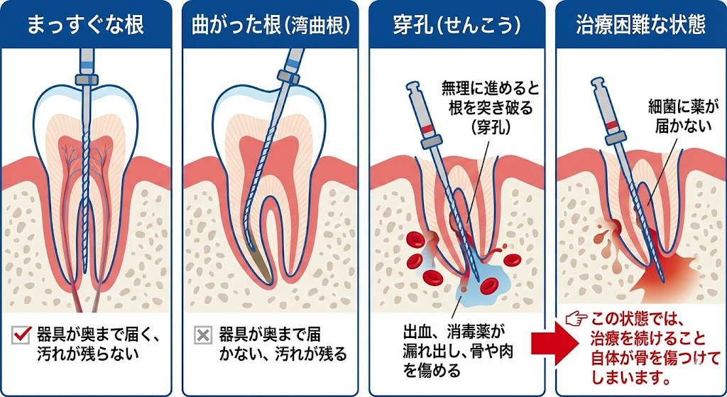 歯を抜きたくない|抜歯と言われた方へ|吉本歯科医院が考える抜歯の基準【香川県高松市】