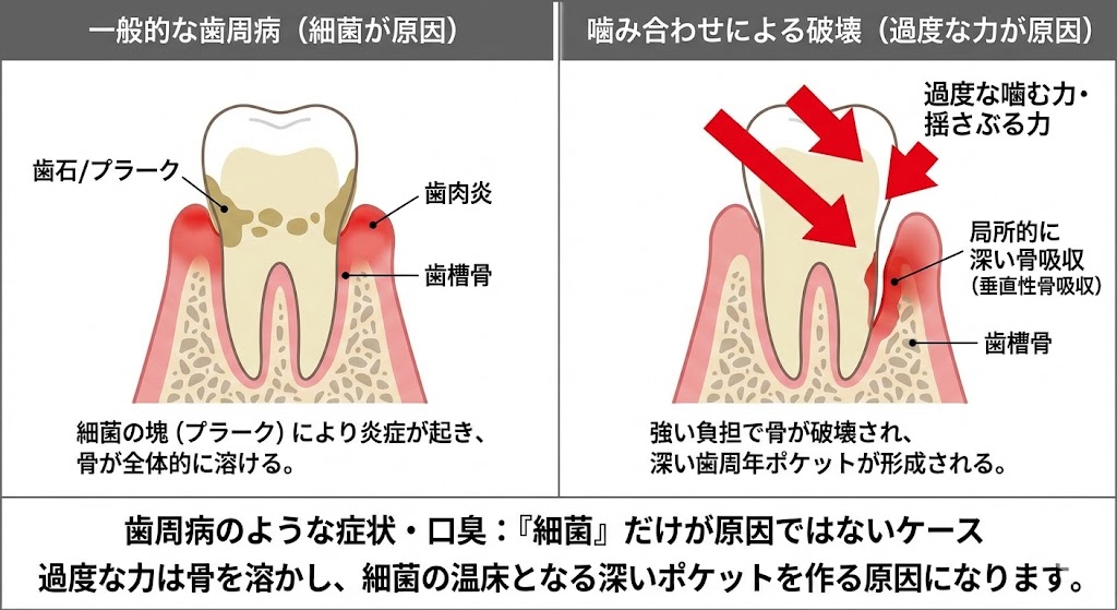 冷たいもので歯がしみる。その原因実は咬み合わせかも|香川県高松市の噛み合わせ専門 吉本歯科医院