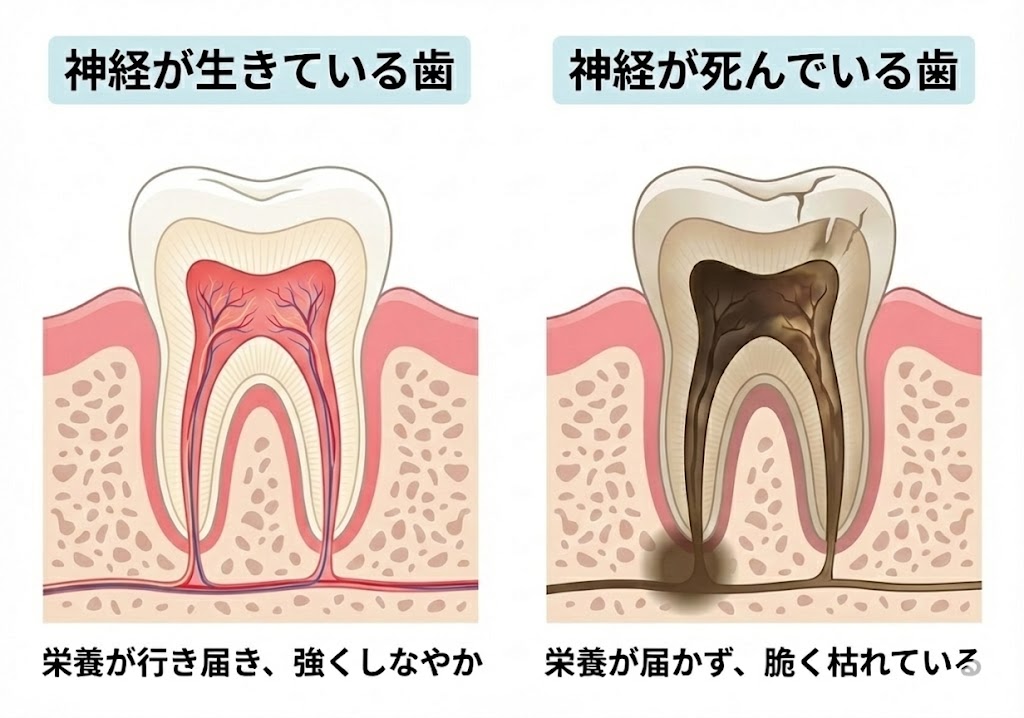 歯の掃除をしていたのに歯根破折で抜歯宣告|咬み合わせ専門の吉本歯科医院【香川県高松市】