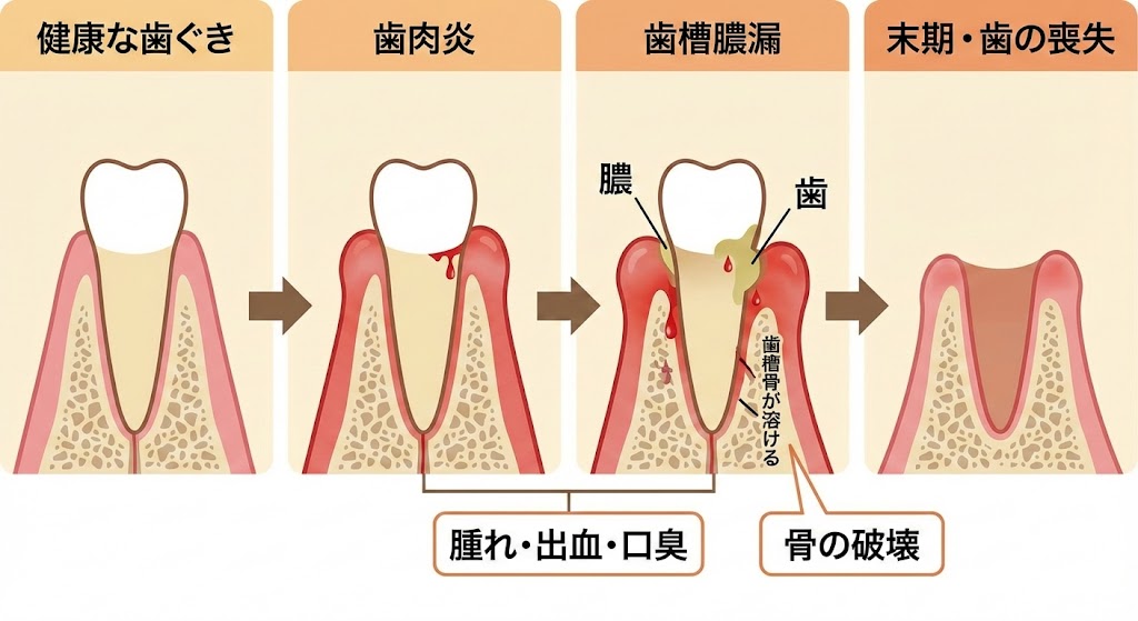 歯槽膿漏でグラグラする歯をもう抜歯しかないと諦める前に｜歯槽膿漏と咬み合わせ｜香川県高松市の吉本歯科医院