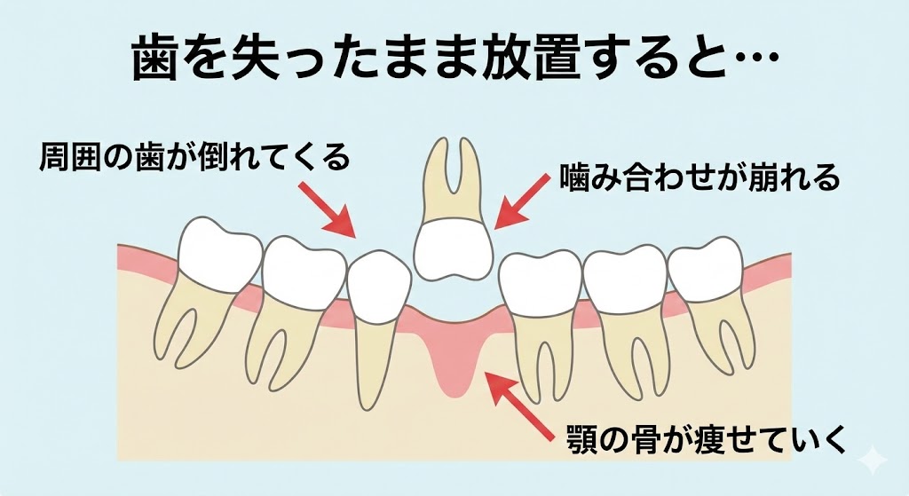 歯を抜いた後、インプラント・ブリッジ・入れ歯どれを選べばいい？咬み合わせ専門の吉本歯科医院【香川県高松市】