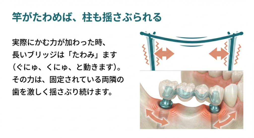 ブリッジ治療の盲点と歯を守るための選択肢｜咬み合わせ専門の吉本歯科医院【香川県高松市】