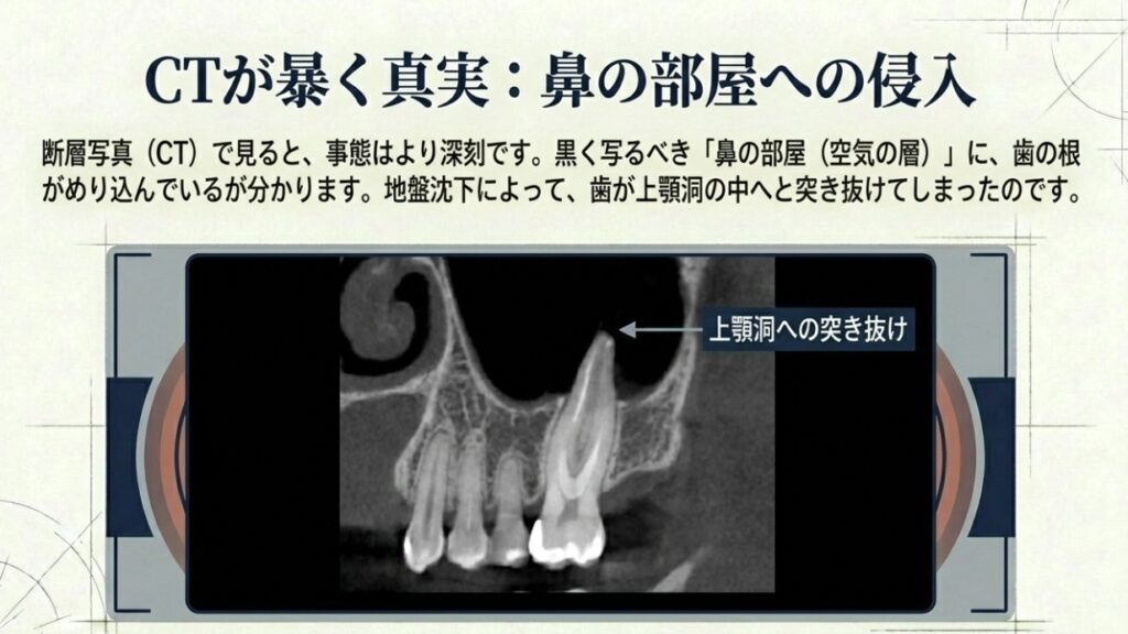 ブリッジを入れた歯に違和感がある方へ。歯の根っこで起きている地盤沈下｜咬み合わせ専門の吉本歯科医院【香川県高松市】