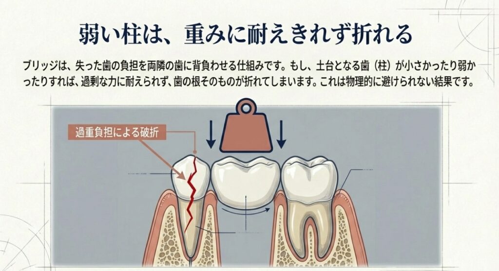 ブリッジを入れた歯に違和感がある方へ。歯の根っこで起きている地盤沈下｜咬み合わせ専門の吉本歯科医院【香川県高松市】
