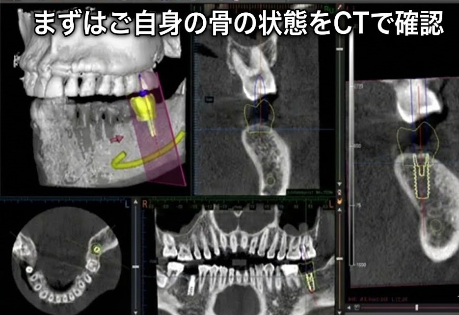 昔の人は入れ歯で噛めていた｜咬み合わせ専門の吉本歯科医院【香川県高松市】