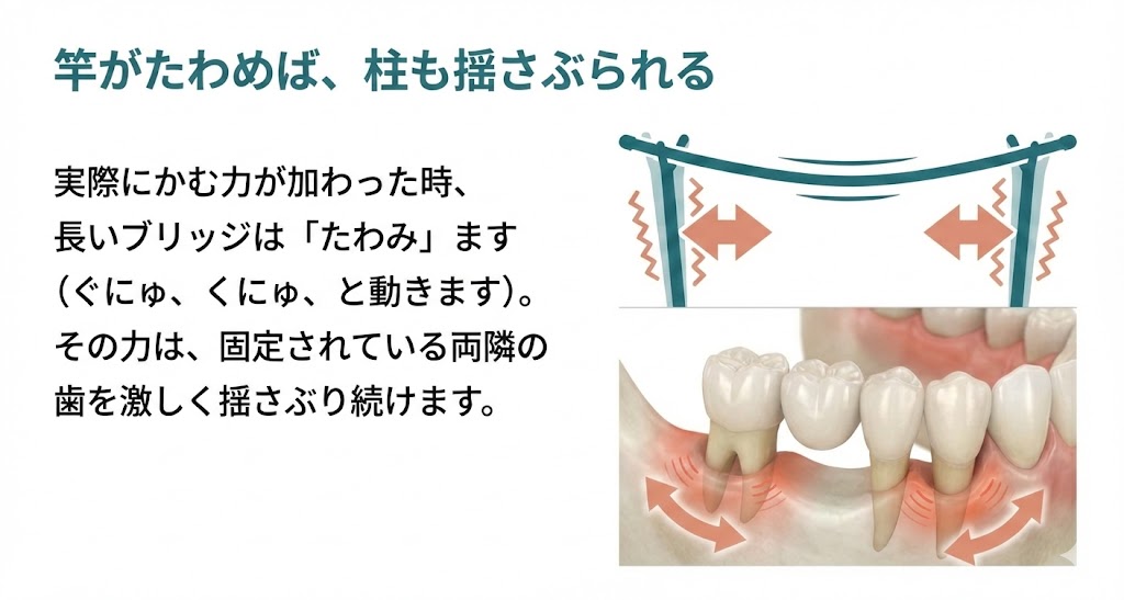 ブリッジ治療の盲点と歯を守るための選択肢|咬み合わせ専門の吉本歯科医院【香川県高松市】
