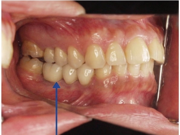 出っ歯になる原因|年齢とともに前歯が出てくる本当の理由|咬み合わせ専門の吉本歯科医院【香川県高松市】