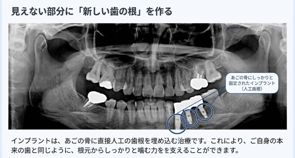 金属の味がする部分入れ歯から快適なインプラントへ|咬み合わせ専門の吉本歯科医院【香川県高松市】