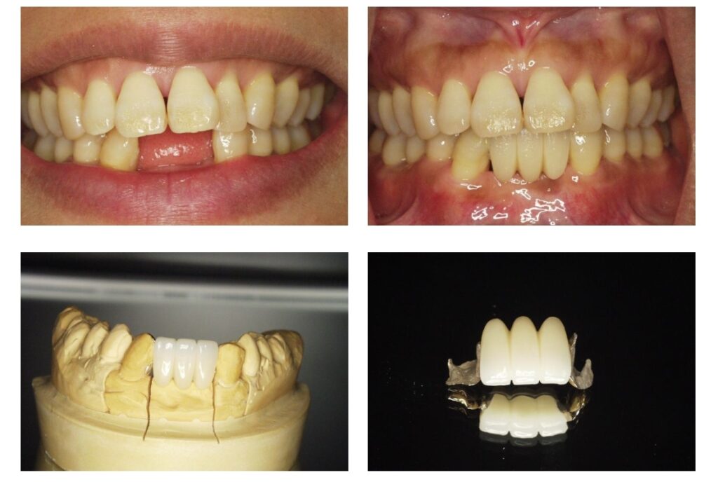 【香川県高松市】50代からの歯の選択。入れ歯・ブリッジ・インプラントの本当の違い｜咬み合わせ専門の吉本歯科医院