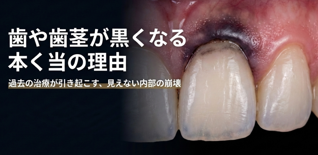 「【香川県高松市】歯や歯茎の黒ずみ、原因は『溶け出す金属』かも?全身の健康を守る治療相談は吉本歯科医院へ」