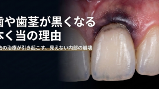 【香川県高松市】歯や歯茎が黒くなる原因は？過去の歯科治療で使用した「金属」のリスクと根本的な解決策