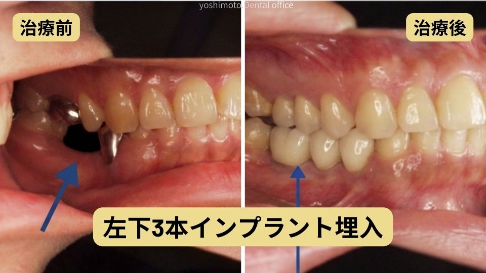 金属の味がする部分入れ歯から快適なインプラントへ|咬み合わせ専門の吉本歯科医院【香川県高松市】