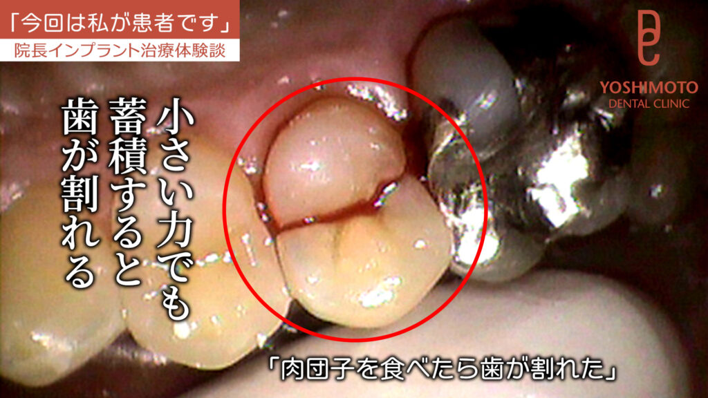 歯が丈夫だと思っている人ほど要注意。50代から増える「歯の破折」｜咬み合わせ専門の吉本歯科医院【香川県高松市】