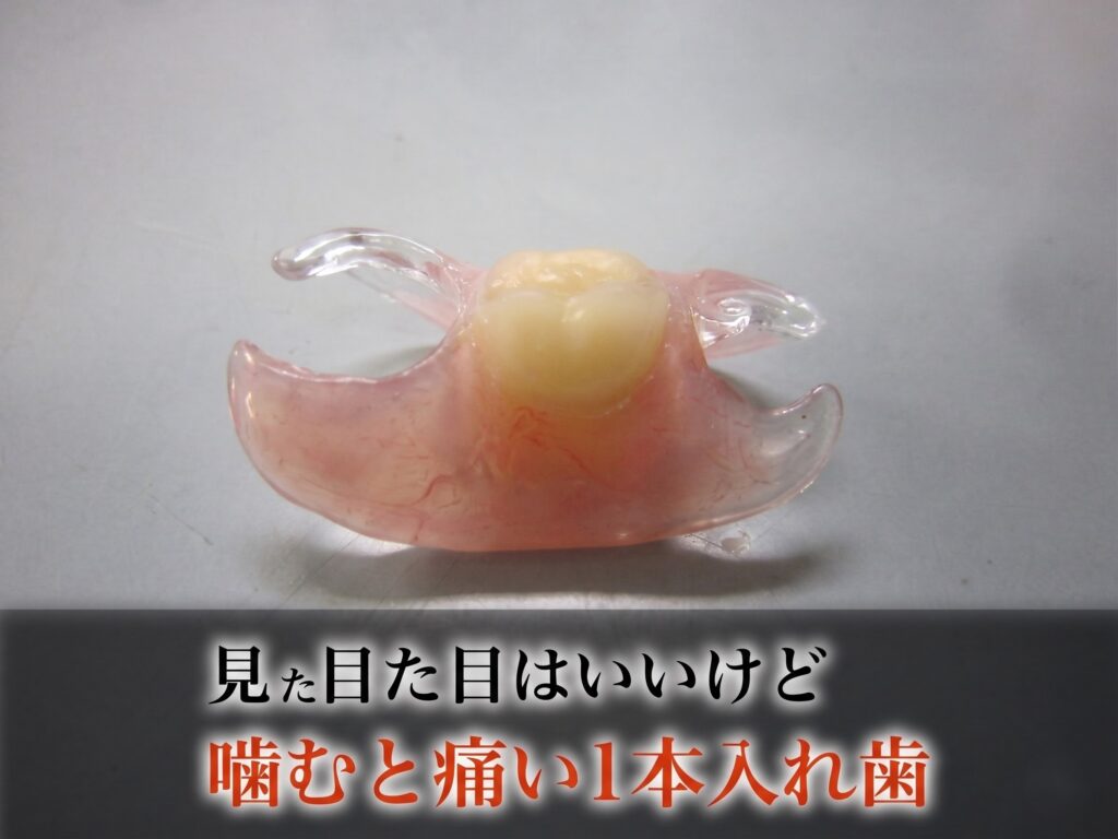 歯を1本抜いたあとの1本義歯｜目立たないけれど噛むと痛いのはなぜ？【香川県高松市・咬み合わせ専門 吉本歯科医院】