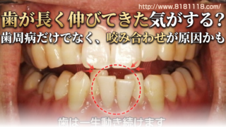 歯が長く伸びてきた気がする？歯周病だけでなく咬み合わせが原因かも