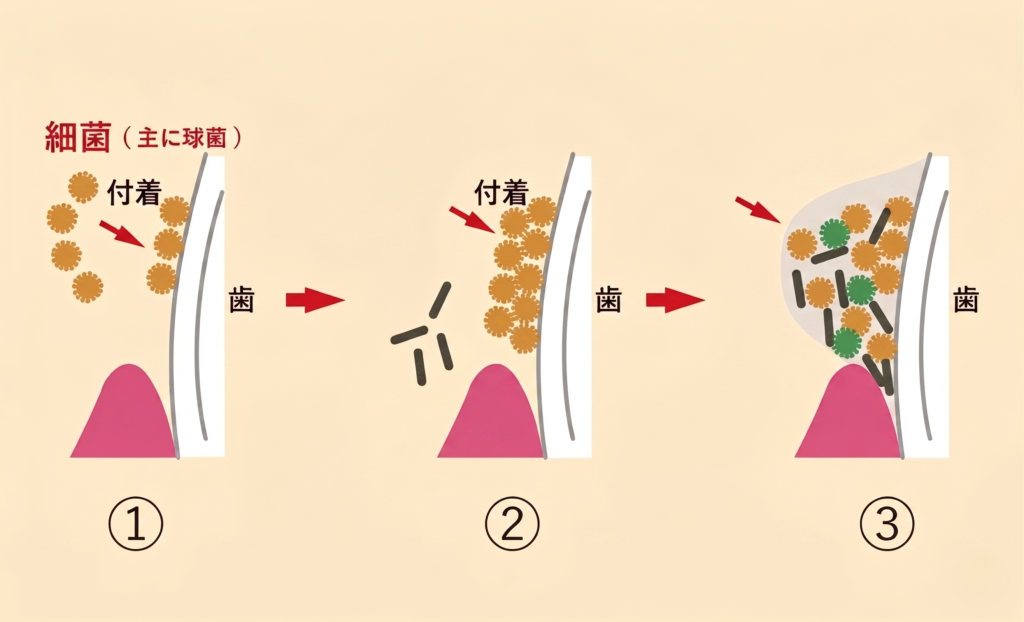 歯垢と歯石の違いとは?見分け方・落とし方をやさしく解説|咬み合わせ専門 吉本歯科医院【香川県高松市】