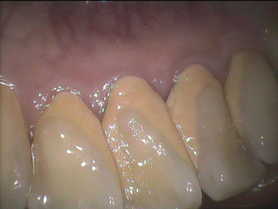 【香川県高松市・吉本歯科医院】歯周病が「毎日歯磨きしているのに治らない」理由を歯科医が解説