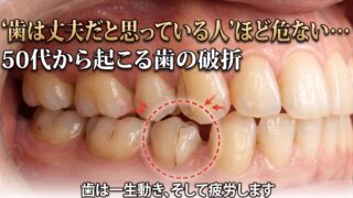 歯が丈夫だと思っている人ほど要注意。50代から増える「歯の破折」