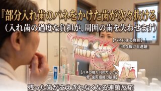 部分入れ歯のバネをかけた歯が次々抜ける理由