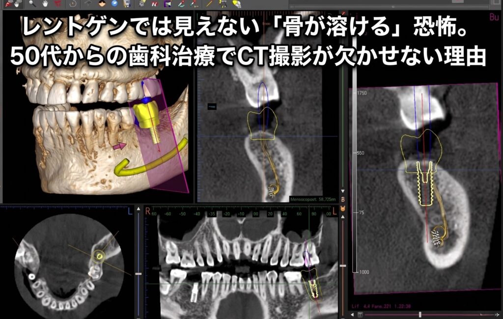 レントゲンでは見えない「骨が溶ける」恐怖。50代からの歯科治療でCT撮影が欠かせない理由【香川県高松市・補綴(ほてつ)専門 吉本歯科医院】