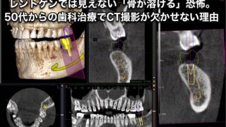 レントゲンでは見えない「骨が溶ける」恐怖。50代からの歯科治療でCT撮影が欠かせない理由