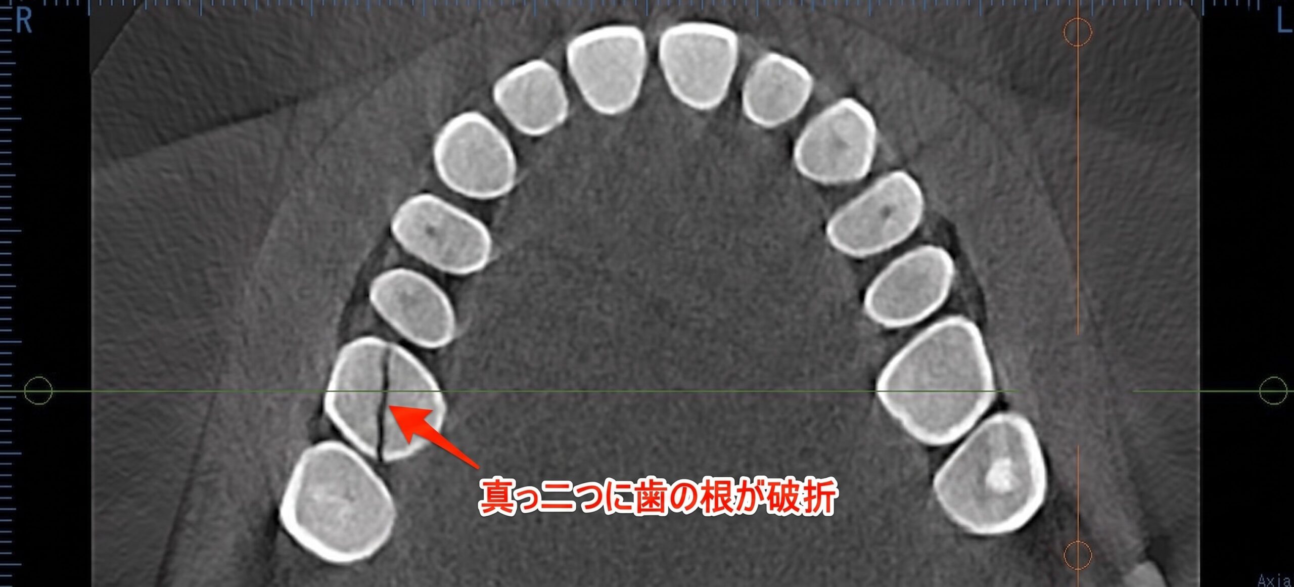 歯が丈夫だと思っている人ほど要注意。50代から増える「歯の破折」｜咬み合わせ専門の吉本歯科医院【香川県高松市】