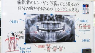 歯医者のレントゲン写真ってどう見るの？自分の歯を守るための「レントゲンの見方」