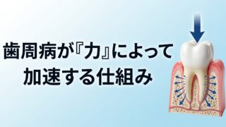 歯周病が「力」によって加速する仕組み｜咬み合わせ専門 吉本歯科医院【香川県高松市】