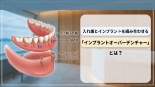 入れ歯とインプラントを組み合わせる「インプラントオーバーデンチャー」とは？