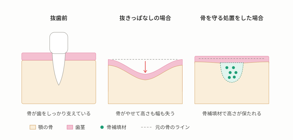 抜歯前に知っておきたいこと。将来のインプラント治療に影響する「抜歯の仕方」とは？|香川県高松市の咬み合わせ専門の吉本歯科医院