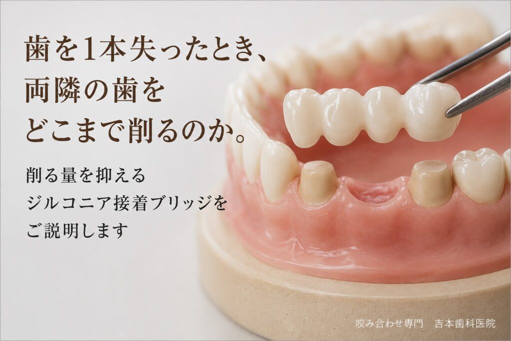 歯を1本失った時、両隣の歯をどこあで削るのか|咬み合わせ専門の吉本歯科医院【香川県高松市】