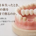 歯を1本失った時、両隣の歯をどこあで削るのか｜咬み合わせ専門の吉本歯科医院【香川県高松市】