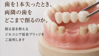歯を1本失ったとき、両隣の歯をどこまで削るのか。削る量を抑えるジルコニア接着ブリッジをご説明します