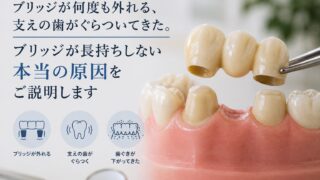 ブリッジが何度も外れる、支えの歯がぐらついてきた。ブリッジが長持ちしない本当の原因をご説明します
