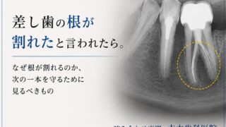 差し歯の根が割れたと言われたら。なぜ根が割れるのか、次の一本を守るために見るべきもの