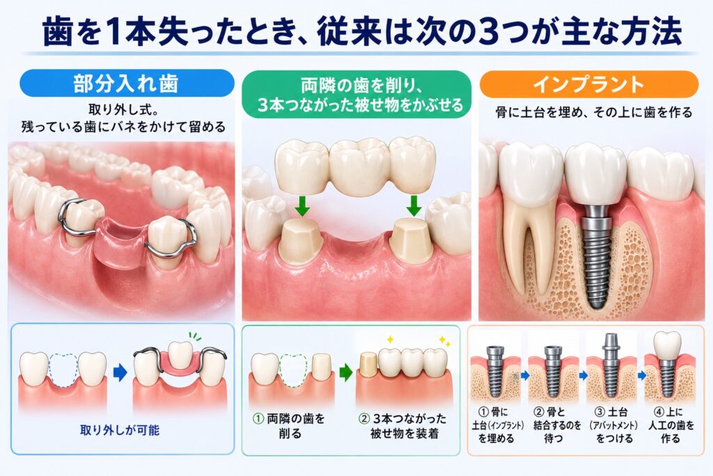 入れ歯もインプラントも避けたい。削る量を抑えるジルコニア接着ブリッジができる場合と、できない場合｜香川県高松市の咬み合わせ専門歯科　𠮷本歯科医院