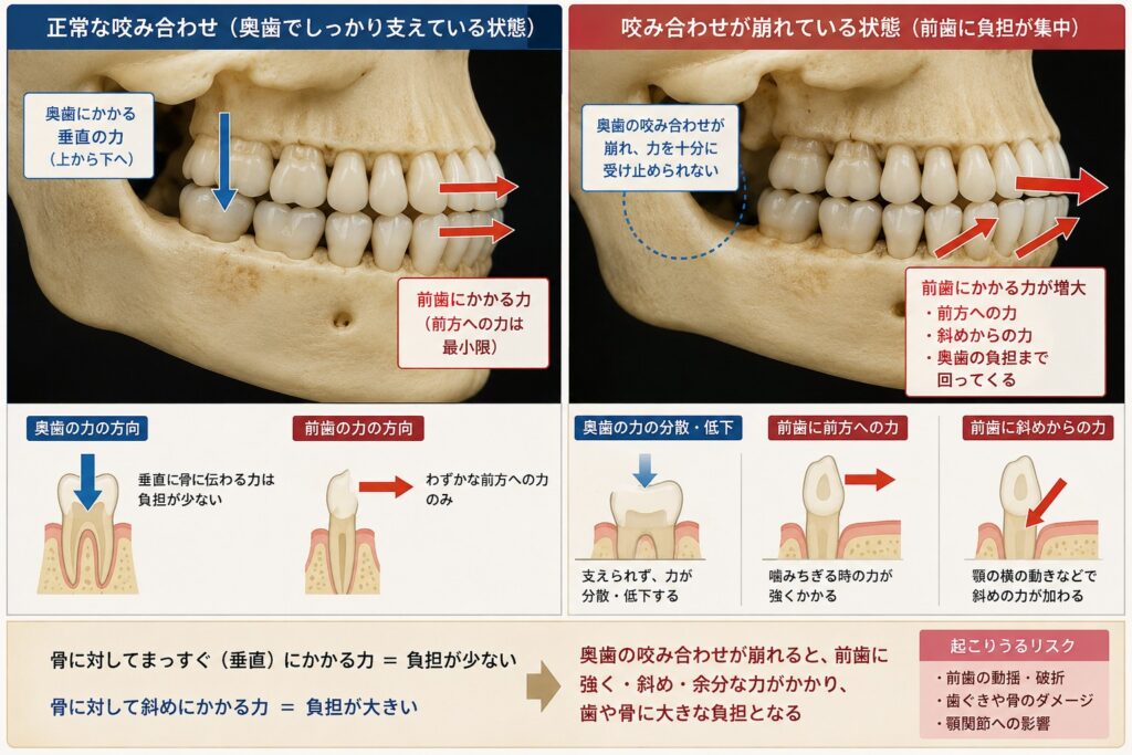 前歯のインプラントは難しいと言われるのはなぜか。見た目を左右するのは人工の歯ではなく、骨と歯ぐきです｜香川県高松市の咬み合わせ専門歯科　𠮷本歯科医院