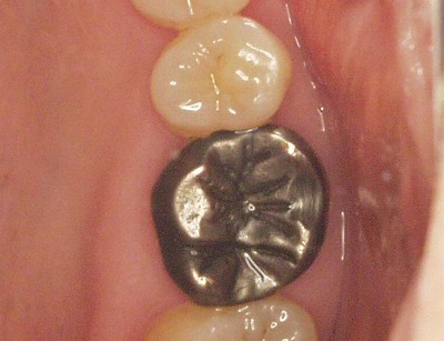 フロスをしていて歯の被せ物が取れてしまった 日本補綴歯科学会専門医 ...